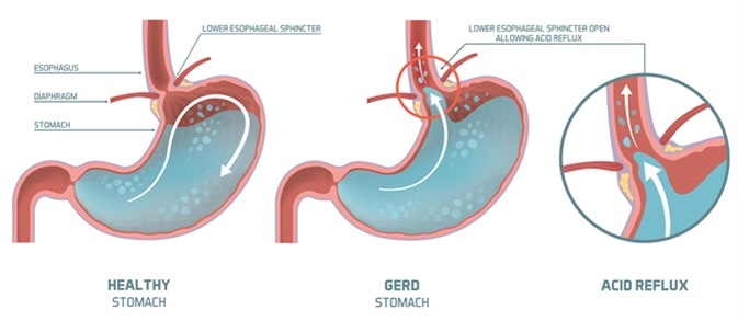 Acid reflux, heartburn and gerd infographic with medical illustration: stomach acid moving up into the esophagus causing acid reflux symptoms. Image Credit: elenabsl / Shutterstock